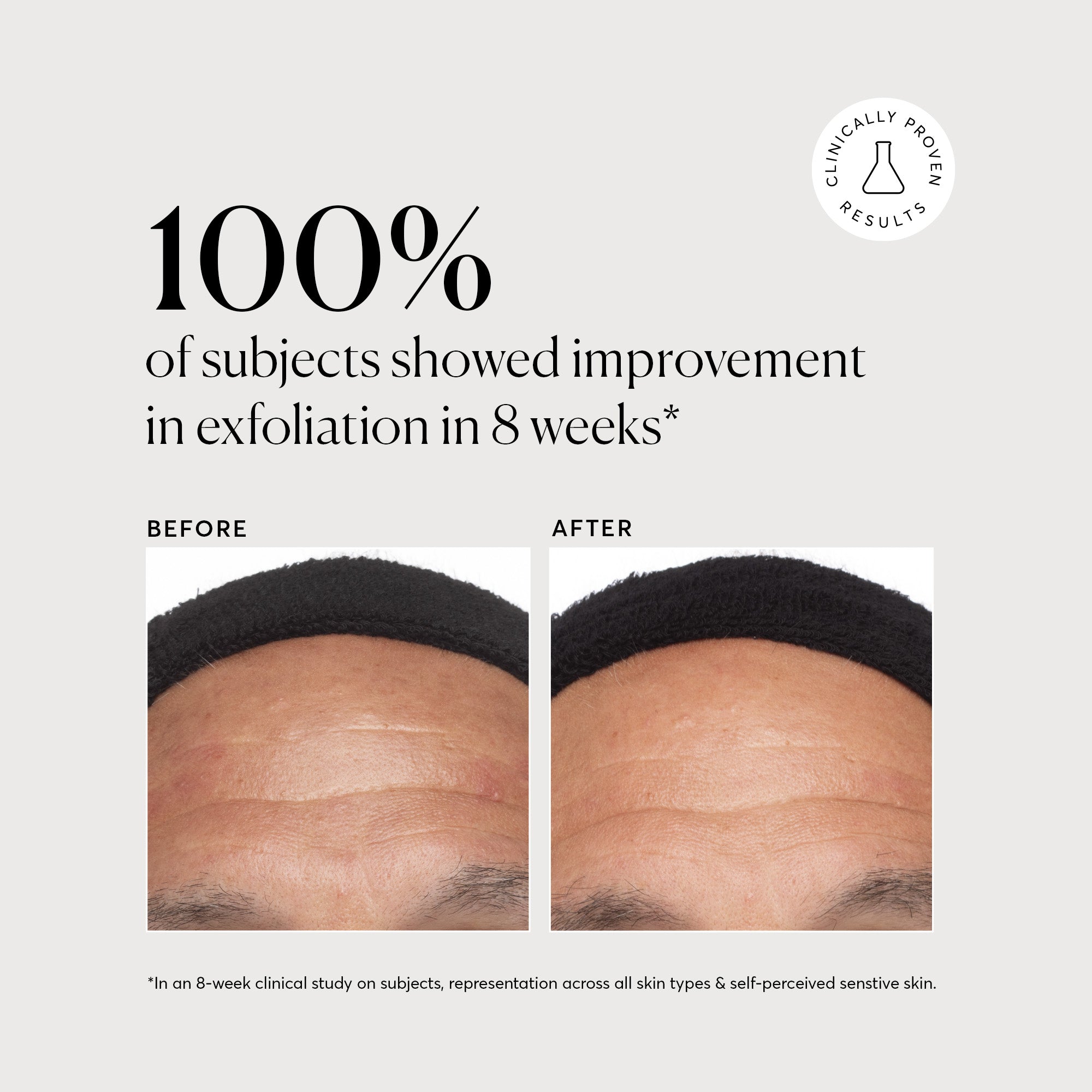 Azelaic Topical Acid 10% - Jumbo