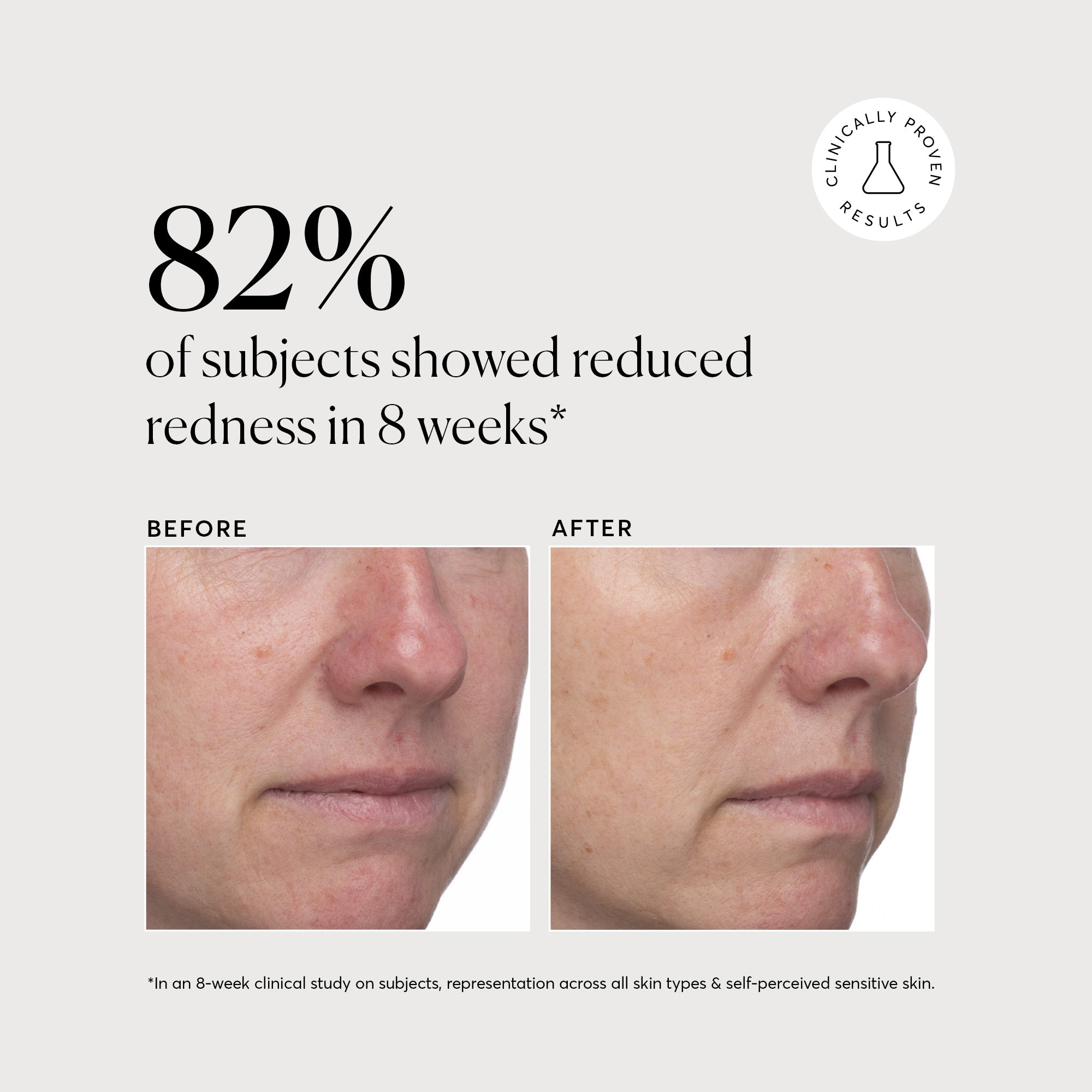 Azelaic Topical Acid 10% - Jumbo